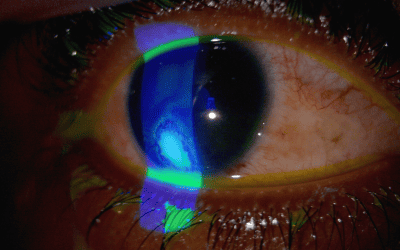 How Long After a Corneal Ulcer Can You Wear Contacts?