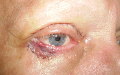 How Is Skin Cancer on the Eyelid Treated?