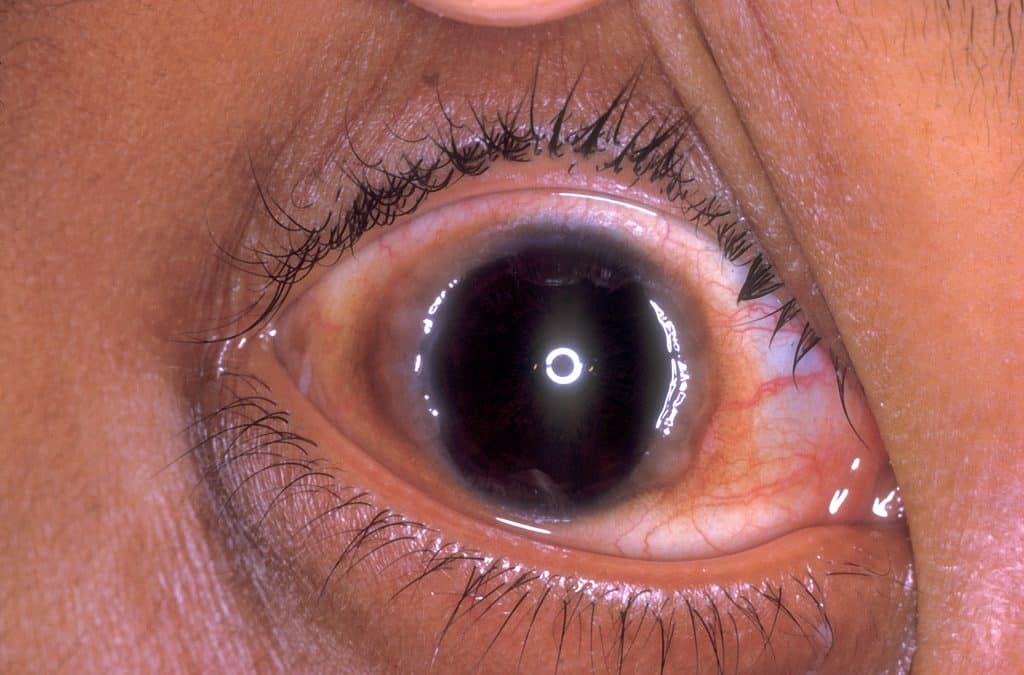 What Are the Stages of a Healing Corneal Ulcer?
