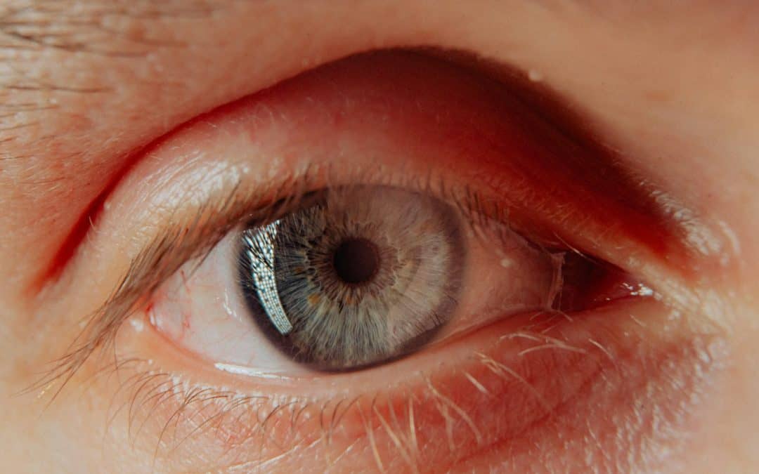 Can Eyelid Inflammation Cause Blurry Vision?