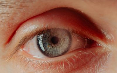 Can Eyelid Inflammation Cause Blurry Vision?